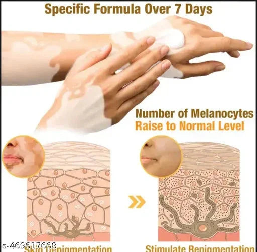 Vitiligo Bee Venom Treatment Cream (Pack of 2) 9242