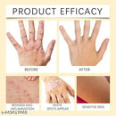 Vitiligo Bee Venom Treatment Cream (Pack of 2) 9242