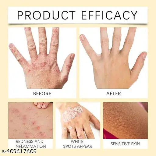 Vitiligo Bee Venom Treatment Cream (Pack of 2) 9242