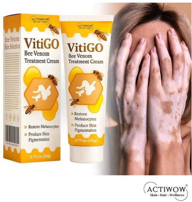 Vitiligo Correcting Cream a person's hands, showcasing its vitiligo treatment benefits.