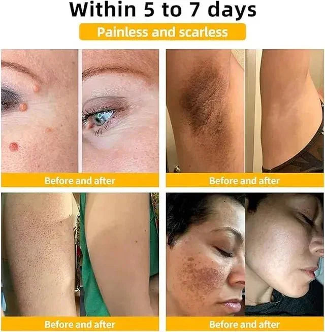 Zidella Skin  Lightening Cream 50g (Pack of 2) - Himalaya Life Care